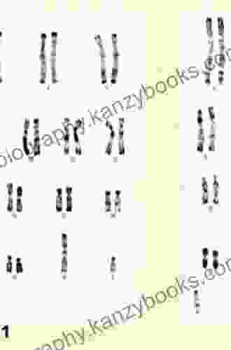 Small Supernumerary Marker Chromosomes (sSMC): A Guide for Human Geneticists and Clinicians